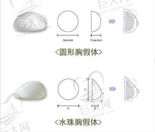 曼托假体