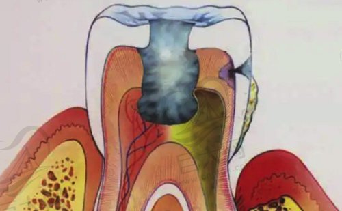 牙髓受损导致牙齿疼痛