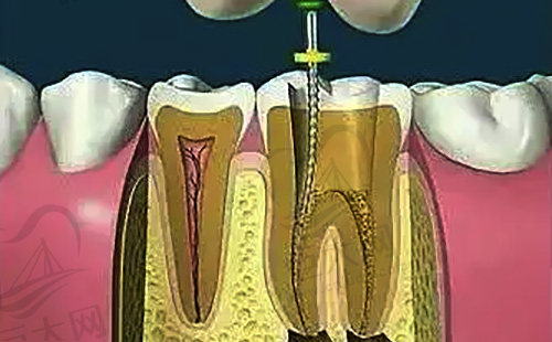 通过根管治疗修复牙齿问题