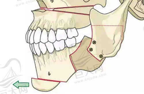 对正颌手术有哪些误解