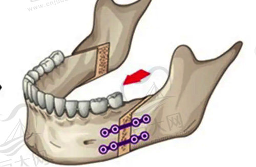 正颌手术的操作示范