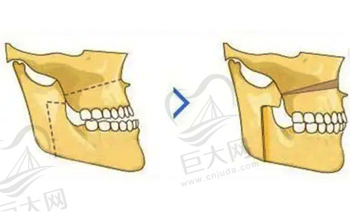正颌手术是几级