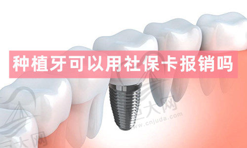 种植牙可以用社保卡报销吗