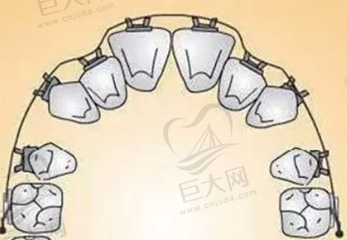 矫正拉力过大