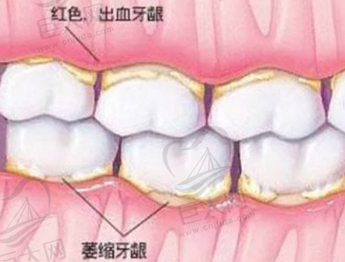 牙龈萎缩