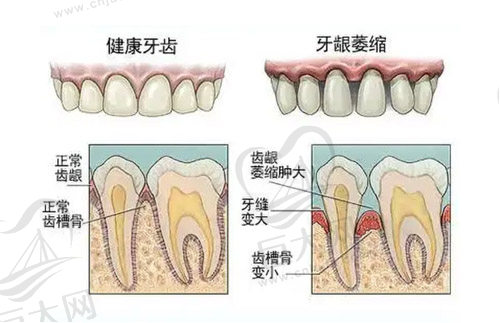 牙龈萎缩