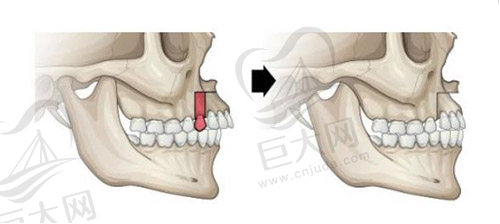 正颌手术