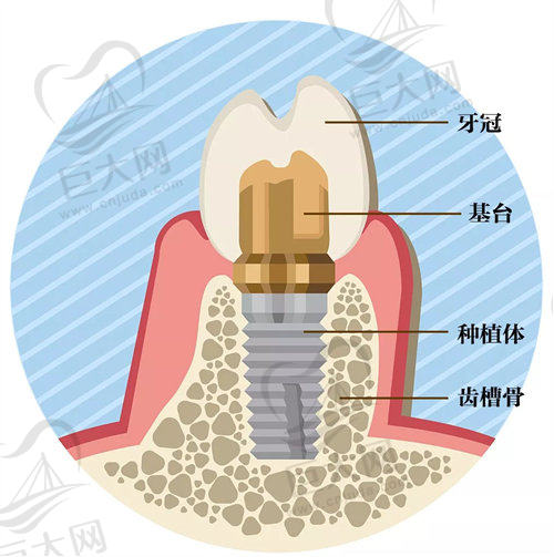 种植牙