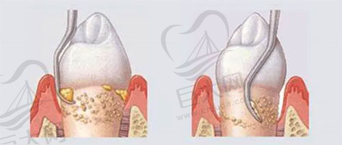 牙周刮治