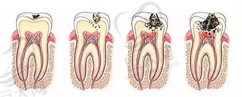 牙齿龋坏变化图