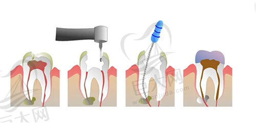 根管治疗