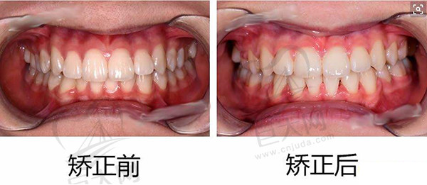 骨性深覆合矫正前后