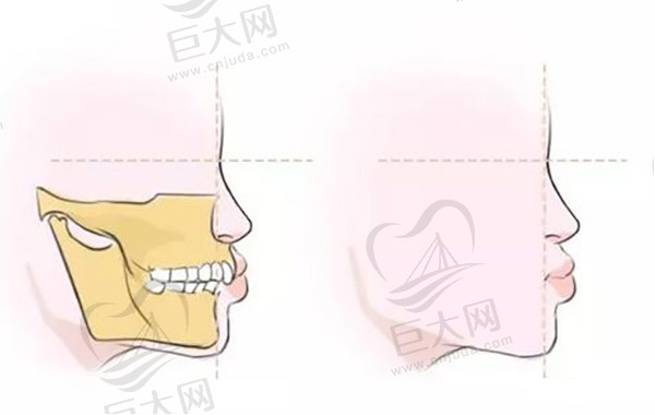 骨性深覆合