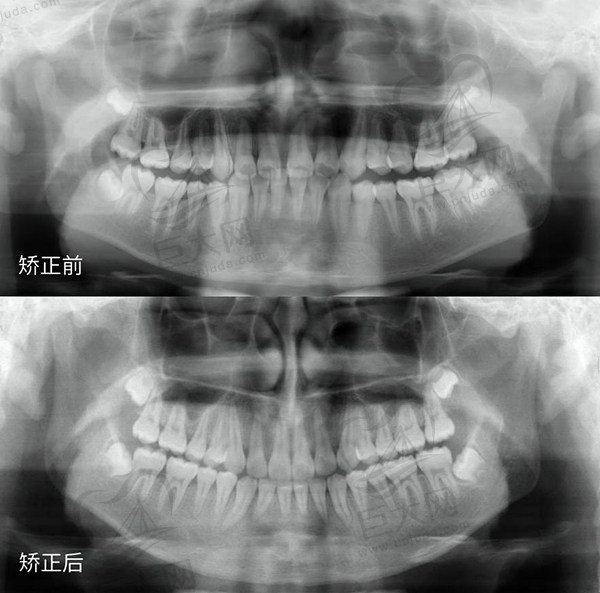 骨性深覆合矫正前后对比图