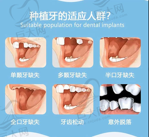 种植牙适应的人群