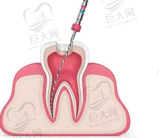 什么情况下必须做根管治疗？