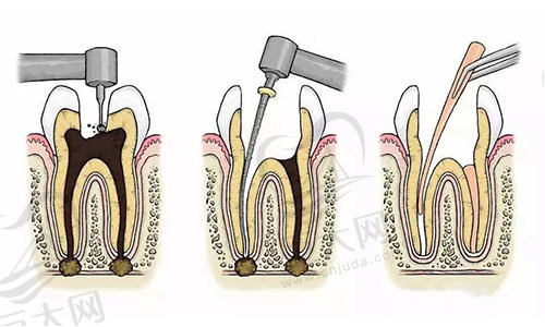 根管治疗步骤
