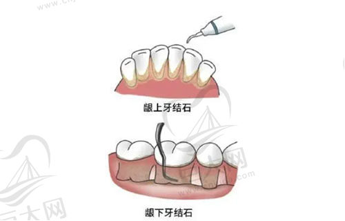 龈下刮治