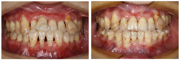 牙周炎正畸治疗