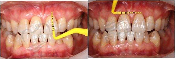 牙周炎治疗