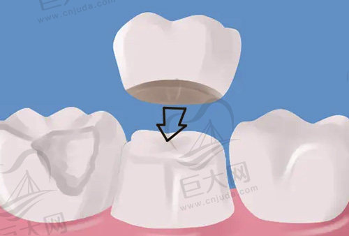 牙冠的修复方式示范