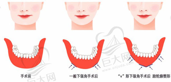 下颌骨十个做了九个后悔是真的吗