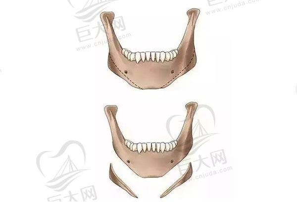 下颌骨十个做了九个后悔是真的吗