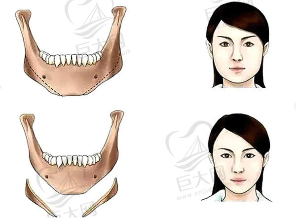 下颌骨十个做了九个后悔是真的吗