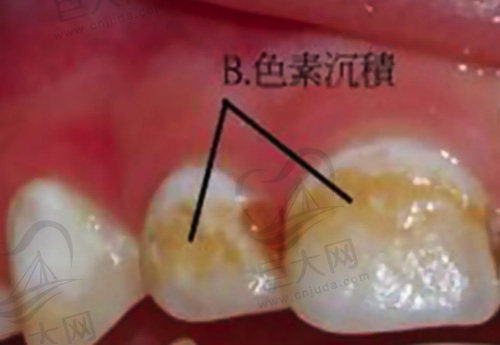 牙齿表面色素沉着