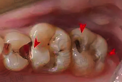儿童牙齿存在牙洞怎么办