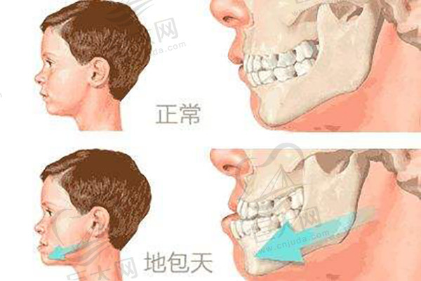 儿童地包天与正常对比图