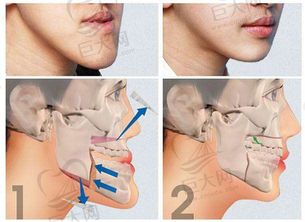 骨性地包天正颌手术治疗对比
