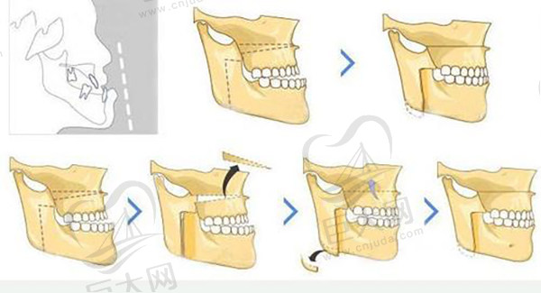 骨性地包天正颌手术过程示意