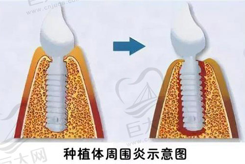 种植体周围炎