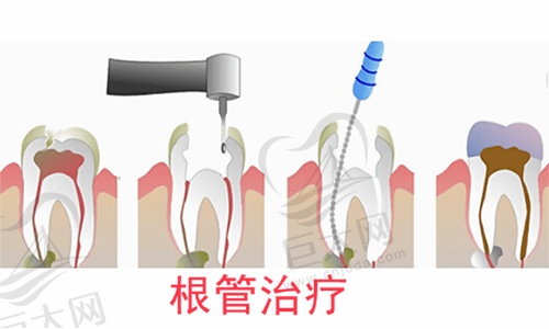 根管治疗