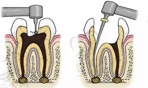 根管治疗