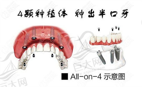 allon4种植牙
