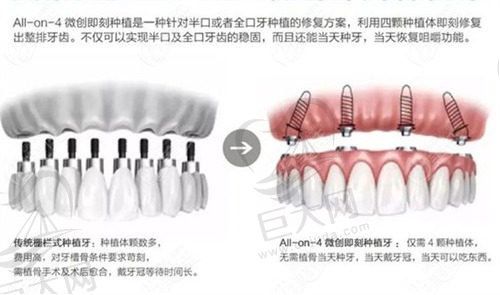 allon4种植牙