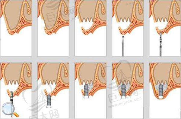 上颌窦外提升术步骤示意