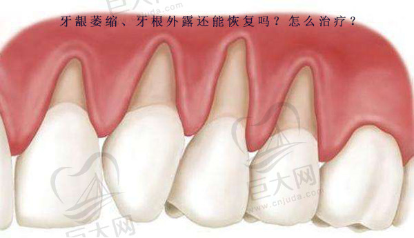 年轻人牙根外露还能恢复吗？