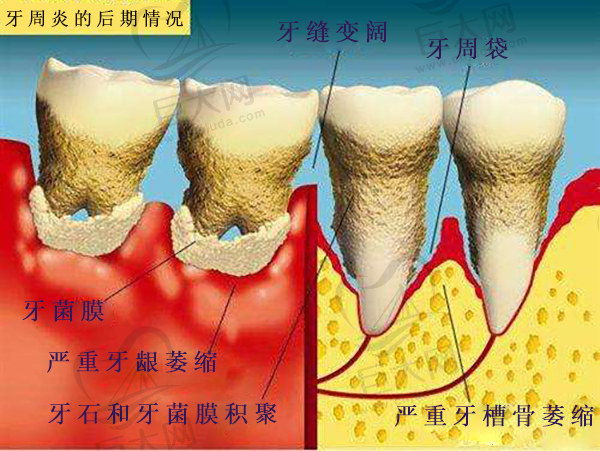 牙根外露是什么原因