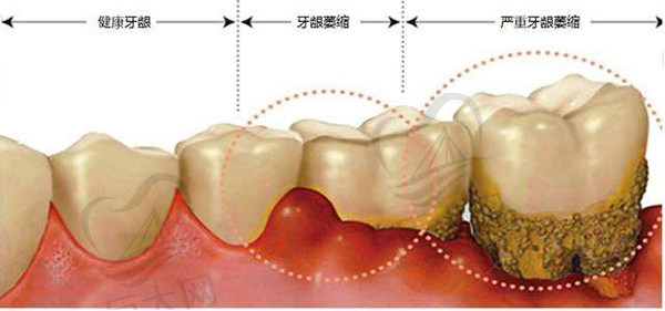 健康牙龈与重度牙龈萎缩对比