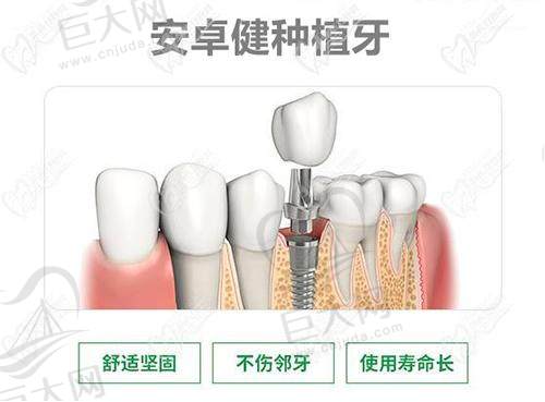 安卓健种植牙