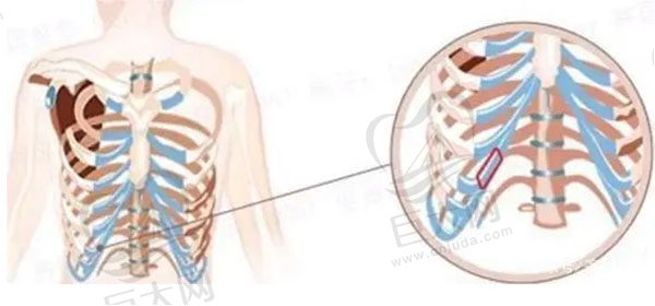 千万别取肋软骨隆鼻，是因为取肋软骨隆鼻对身体有伤害吗？