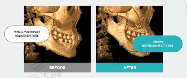 下颌角手术副作用大吗？看看韩国TS整形医院李相均院长对下颌角术后讲解