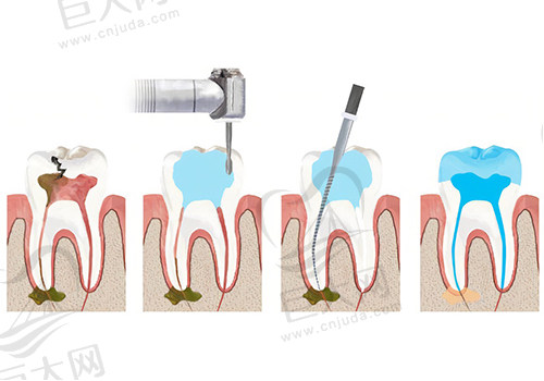 根管治疗的步骤