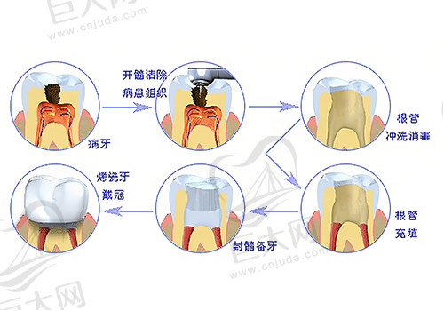 根管治疗治疗步骤