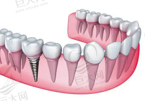 种植牙危害