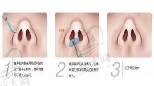 舒铂超肋鼻