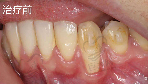 牙龈再生术成效好术前